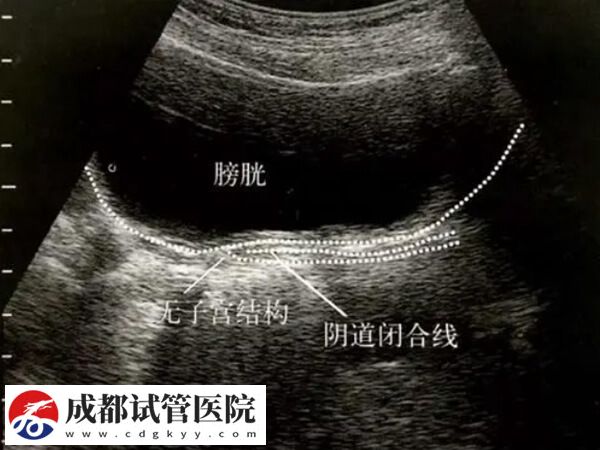 什么是始基子宮？始基子宮的治療方法有哪些？(圖7)