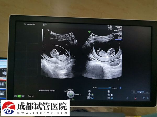 試管嬰兒懷雙胞胎同樣有風險，五大危害已羅列在此！(圖1)